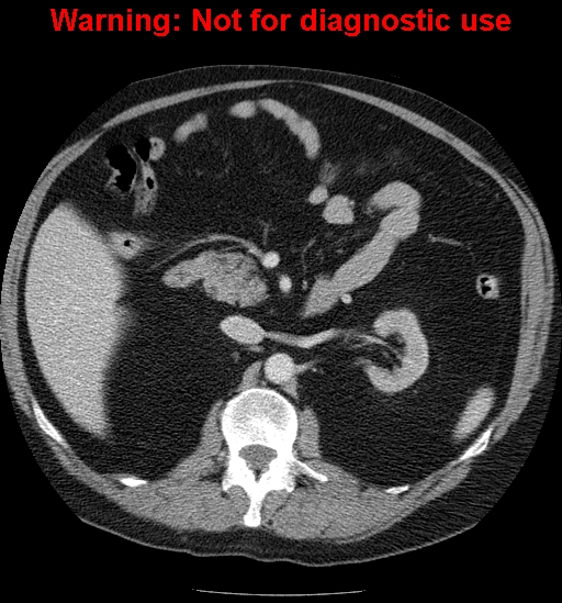 File:Bosniak renal cyst - type IV (Radiopaedia 23402-23466 D 27).jpg