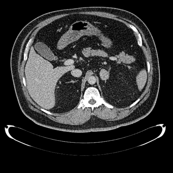 Bosniak renal cyst - type IV (Radiopaedia 24244-24518 C 90).jpg