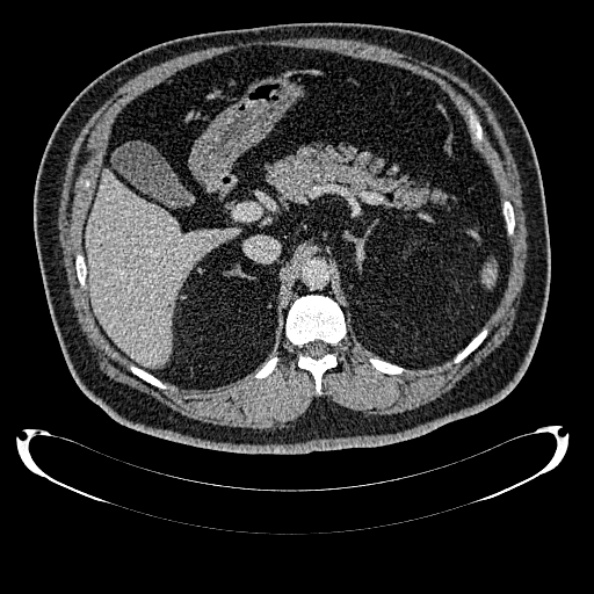 Bosniak renal cyst - type IV (Radiopaedia 24244-24518 C 96).jpg