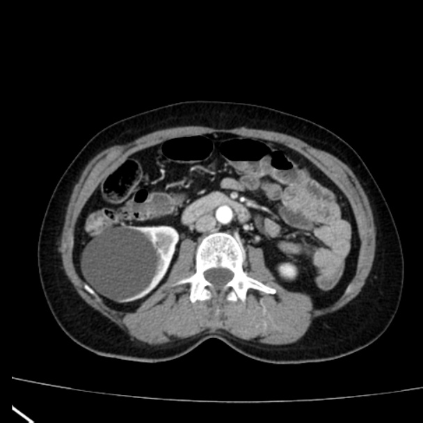 Bosniak renal cyst - type I (Radiopaedia 27479-27675 renal cortical phase 41).jpg