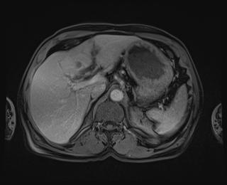 File:Bouveret syndrome (Radiopaedia 61017-68856 Axial T1 C+ fat sat 24).jpg