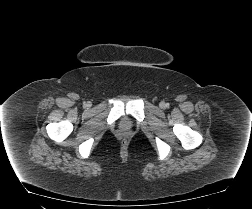 Bowel and splenic infarcts in acute lymphocytic leukemia (Radiopaedia 61055-68913 A 126).jpg