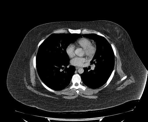 Bowel and splenic infarcts in acute lymphocytic leukemia (Radiopaedia 61055-68913 A 3).jpg