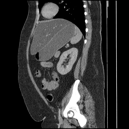 File:Bowel and splenic infarcts in acute lymphocytic leukemia (Radiopaedia 61055-68913 C 30).jpg
