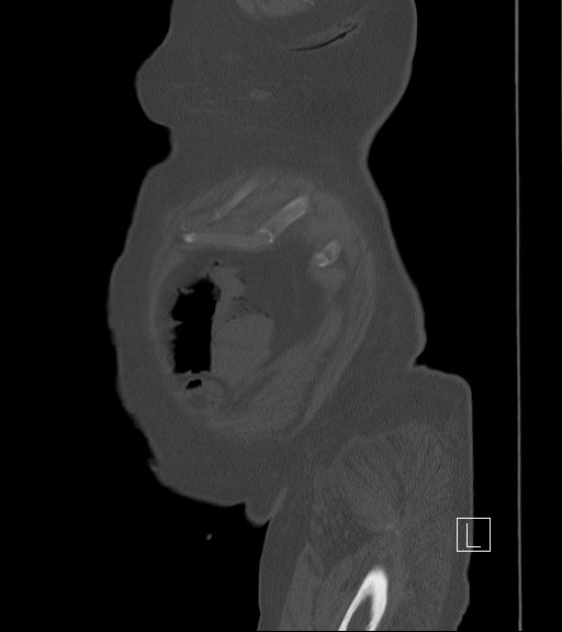 Bowel ischemia secondary to SMA occlusion with extensive portomesenteric venous gas (Radiopaedia 54656-60871 Sagittal bone window 109).jpg