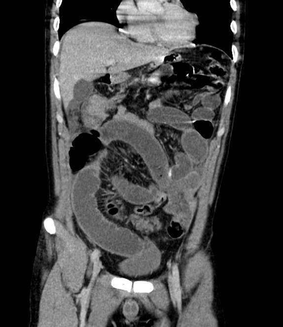 Bowel obstruction from colon carcinoma (Radiopaedia 22995-23028 C 23).jpg