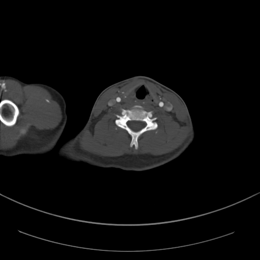 Brachiocephalic trunk pseudoaneurysm (Radiopaedia 70978-81191 Axial bone window 27).jpg