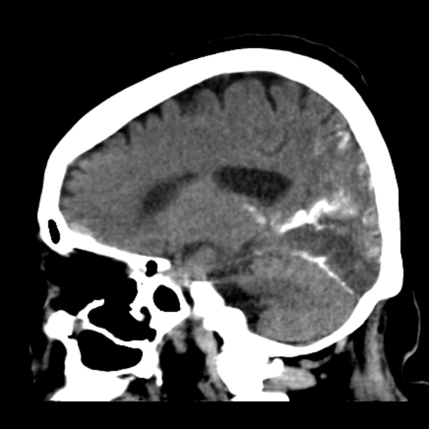 Brain cortical laminar necrosis (Radiopaedia 25822-25971 non-contrast 31).jpg