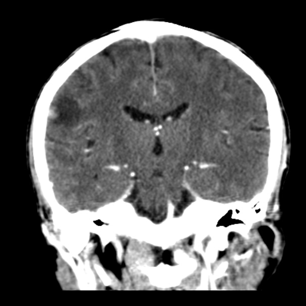 Brain metastases from lung cancer (Radiopaedia 24480-24781 Coronal C+ delayed 34).jpg
