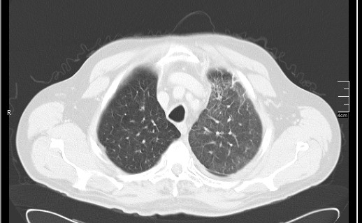Brain metastases from squamocellular lung cancer (Radiopaedia 56515-63219 Axial lung window 18).jpg