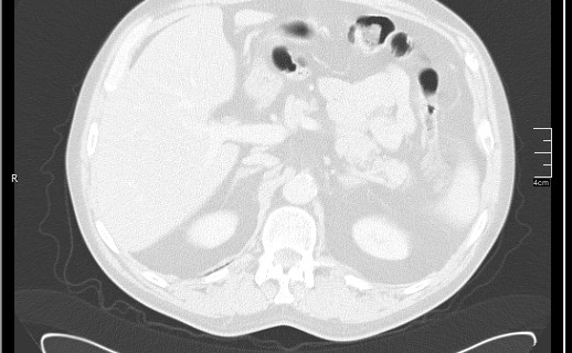 Brain metastases from squamocellular lung cancer (Radiopaedia 56515-63219 Axial lung window 65).jpg