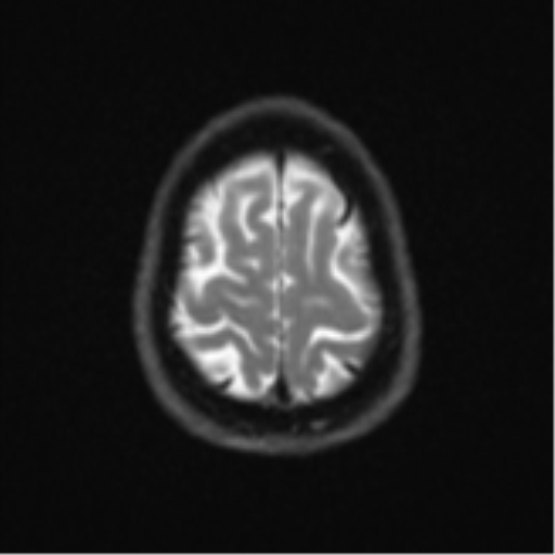 Brain metastasis (large cystic mass) (Radiopaedia 47497-52107 Axial DWI 24).png