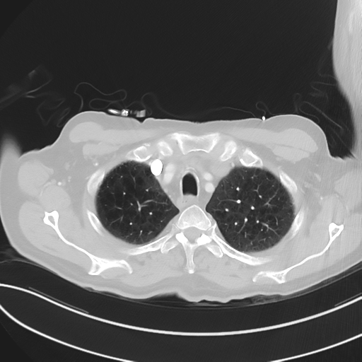 File:Brain metastasis (lung cancer) (Radiopaedia 48289-53180 Axial lung window 12).png
