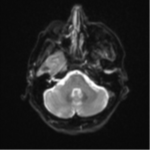 Brain metastasis (sarcoma) (Radiopaedia 47576-52209 Axial DWI 7).png