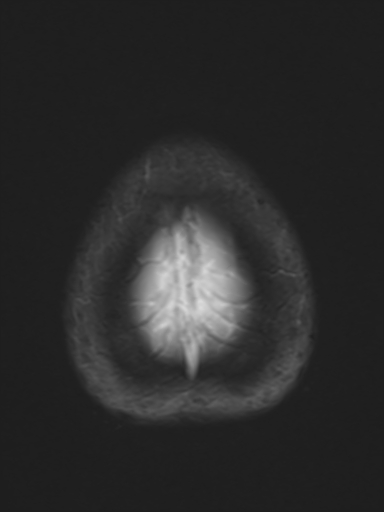 File:Brain metastasis as initial presentation of non-small cell lung cancer (Radiopaedia 65122-74126 Axial T2* 18).jpg
