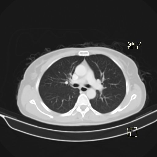 File:Brain metastasis as initial presentation of non-small cell lung cancer (Radiopaedia 65122-74127 Axial lung window 20).jpg