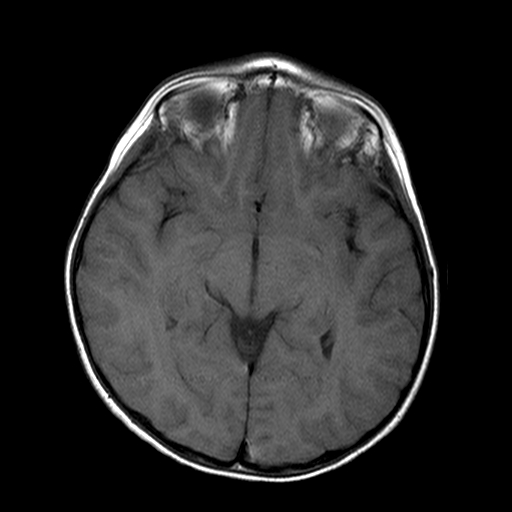 File:Brainstem ganglioglioma (Radiopaedia 10763-11224 Axial T1 11).jpg