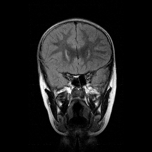 File:Brainstem ganglioglioma (Radiopaedia 10763-11224 Coronal FLAIR 14).jpg