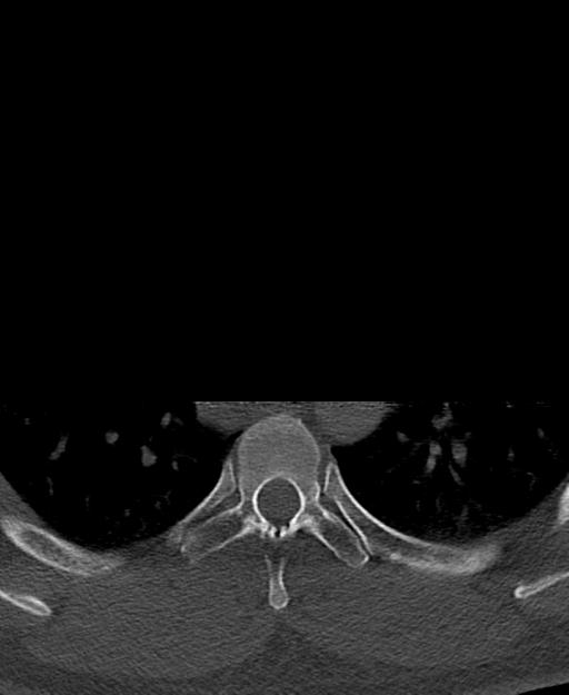 Branchial cleft cyst (Radiopaedia 31167-31875 Axial bone window 89).jpg