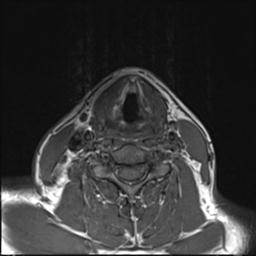 File:Branchial cleft cyst (Radiopaedia 31167-31876 Axial T1 3).jpg