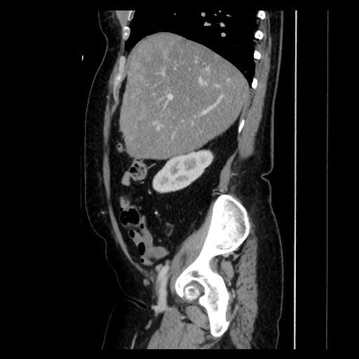 Breast cancer pseudocirrhosis with lobar invovlement (Radiopaedia 81080-94670 D 87).jpg