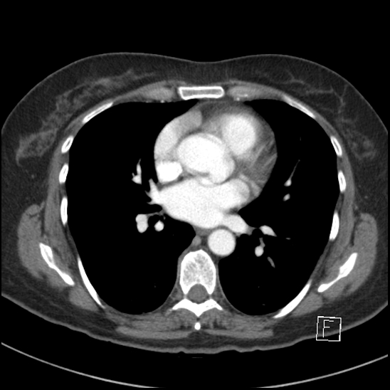Breast metastases from renal cell cancer (Radiopaedia 79220-92225 A 52).jpg