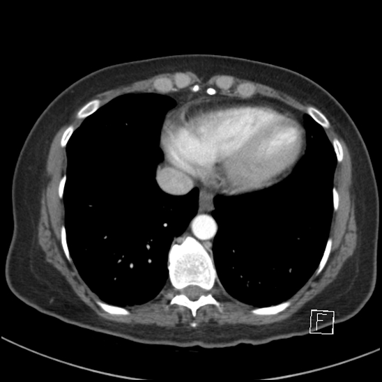 File:Breast metastases from renal cell cancer (Radiopaedia 79220-92225 A 70).jpg