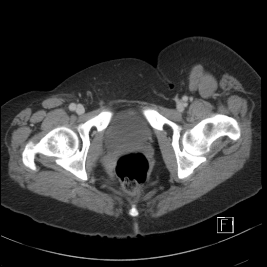 File:Breast metastases from renal cell cancer (Radiopaedia 79220-92225 C 119).jpg