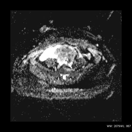 File:Broad ligament fibroid (Radiopaedia 49135-54241 Axial ADC 10).jpg