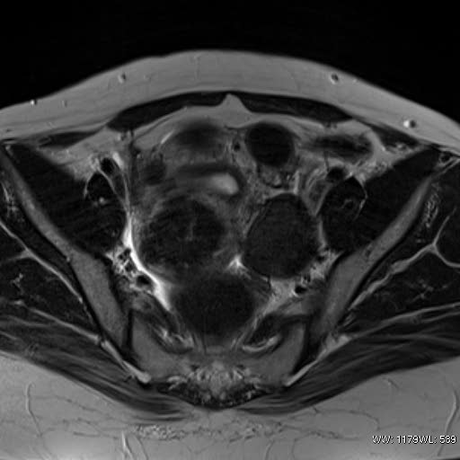 File:Broad ligament fibroid (Radiopaedia 49135-54241 Axial T2 15).jpg