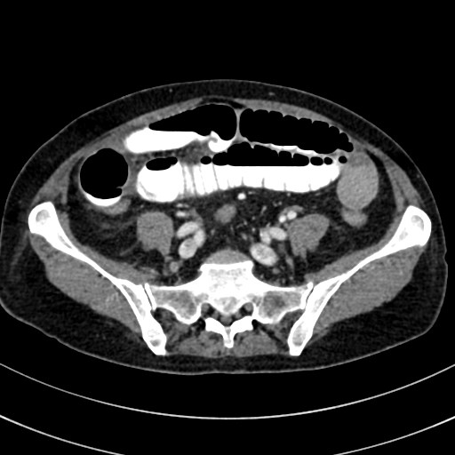 File:Broad ligament hernia (Radiopaedia 84802-100276 A 64).jpg