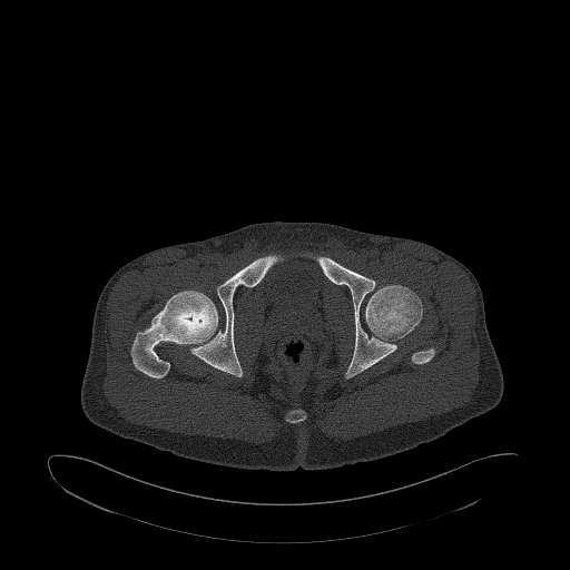 Brodie abscess- femoral neck (Radiopaedia 53862-59966 Axial bone window 160).jpg