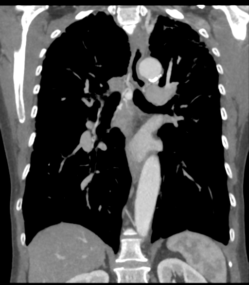 File:Bronchial artery aneurysms (Radiopaedia 42282-45385 Coronal C+ delayed 40).png