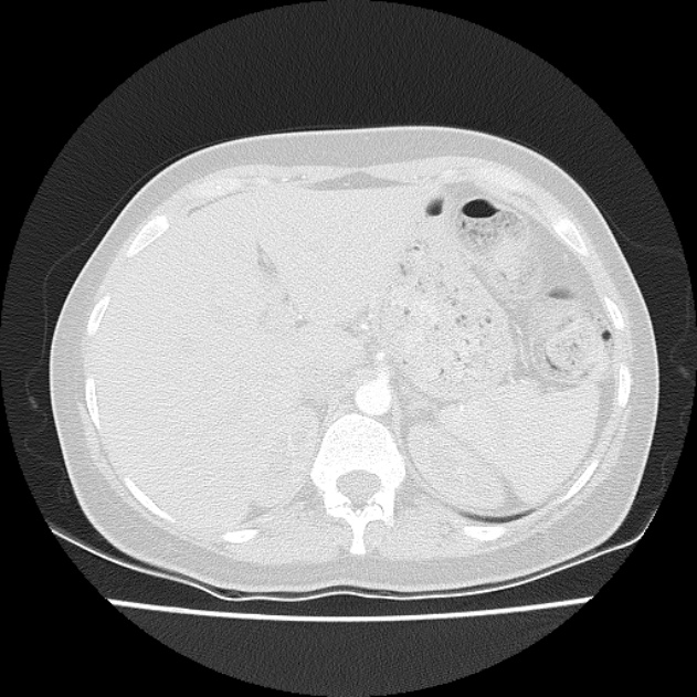 Bronchial atresia (Radiopaedia 22965-22992 Axial lung window 4).jpg