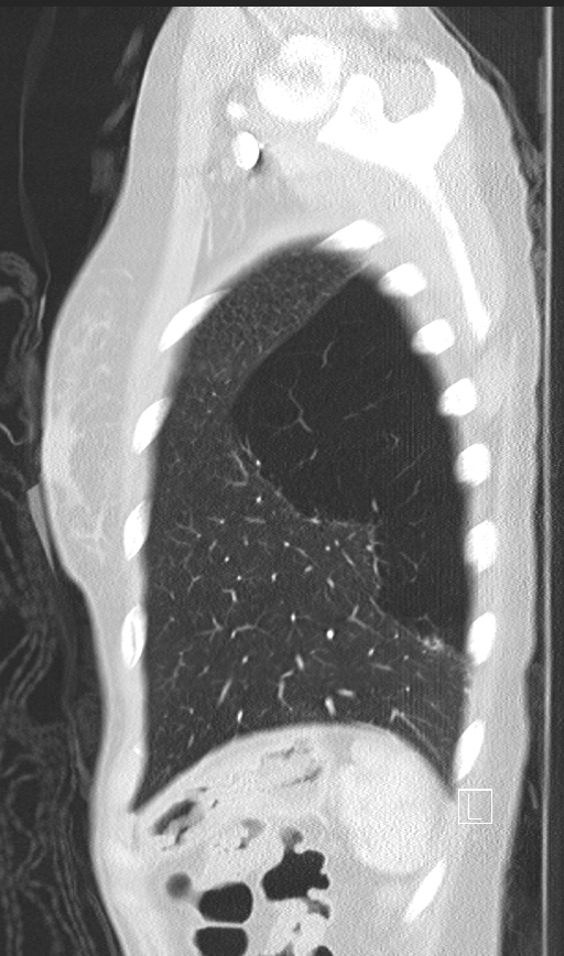 Bronchial atresia (Radiopaedia 73677-84470 Sagittal lung window 48).jpg