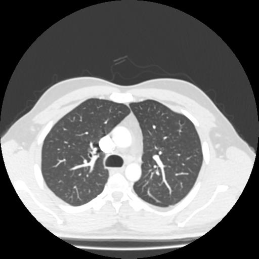 Bronchial carcinoid (Radiopaedia 80013-93291 Axial lung window 34).jpg