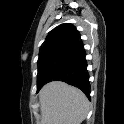 Bronchial carcinoid tumor (Radiopaedia 67377-76764 E 12).jpg