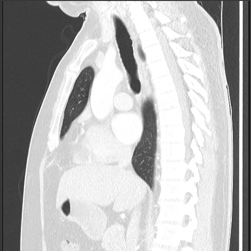 Bronchial carcinoid tumor (Radiopaedia 67377-76764 Sagittal lung window 34).jpg