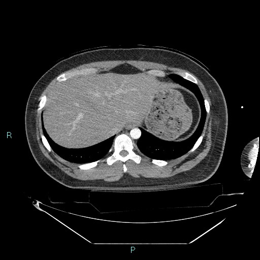 File:Bronchial carcinoid tumor (Radiopaedia 78272-90870 B 104).jpg