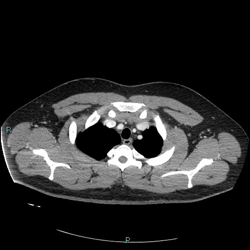 Bronchial carcinoid tumor (Radiopaedia 78272-90875 A 21).jpg