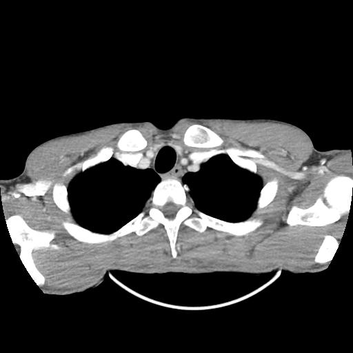 Bronchial carcinoid tumor causing right lower lobe collapse (Radiopaedia 83495-98594 A 3).jpg