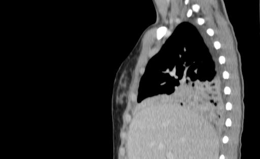 Bronchial mucoepidermoid carcinoma (Radiopaedia 57023-63895 Sagittal 57).jpg