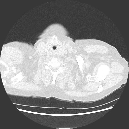 Bronchial stenosis - lung transplant (Radiopaedia 73133-83848 Axial lung window 1).jpg