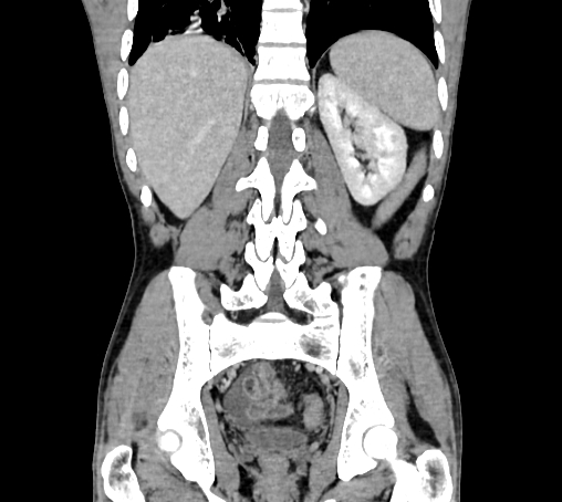 Bronchiectasis in Crohn disease (Radiopaedia 60311-67977 C 60).jpg