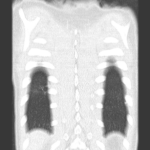 File:Bronchiolotis obliterans (Radiopaedia 73769-84575 Coronal lung window 35).jpg