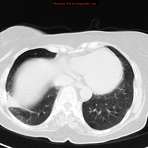 File:Bronchoalveolar carcinoma (BAC) (Radiopaedia 13436-13392 Axial lung window 38).jpg