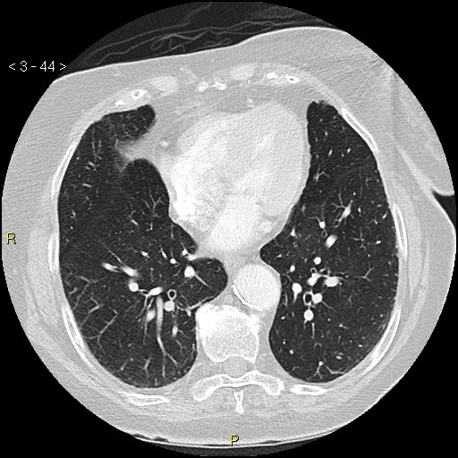 Bronchogenic carcinoma as an incidental finding (Radiopaedia 16453-16130 Axial lung window 44).jpg