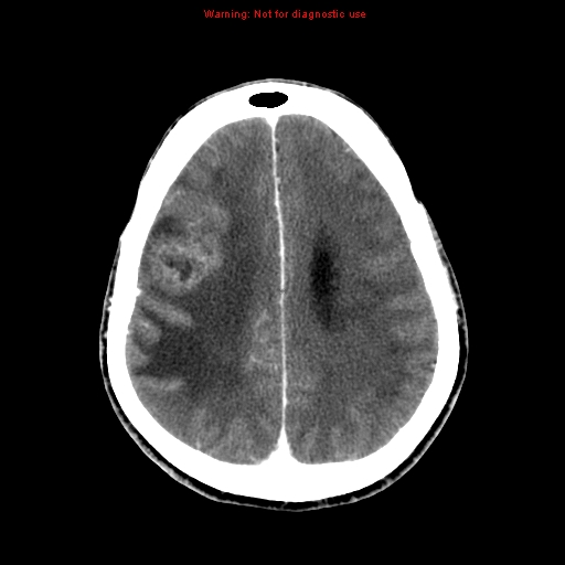 File:Bronchogenic carcinoma brain metastasis (Radiopaedia 9286-9970 B 21).jpg