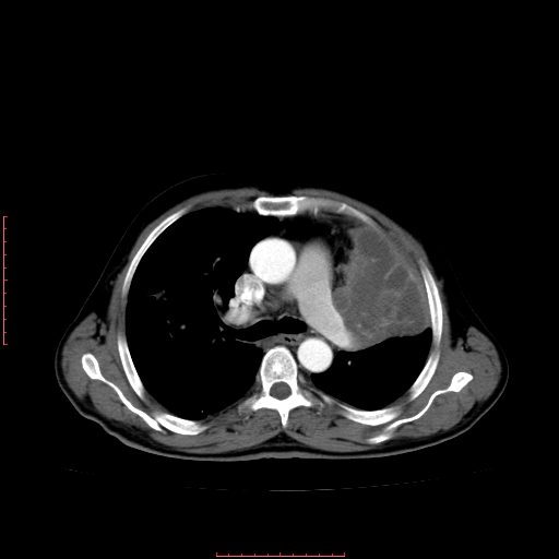 File:Bronchogenic carcinoma with left atrial large deposit - T4N3M1a (Radiopaedia 42316-45428 A 13).jpg