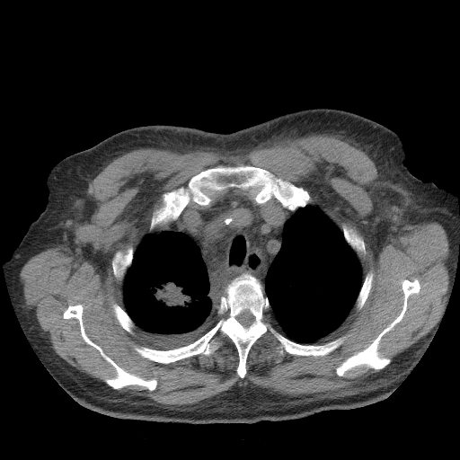 File:Bronchogenic carcinoma with metastatic lymphadenopathy (Radiopaedia 37671-39569 Axial non-contrast 11).jpg